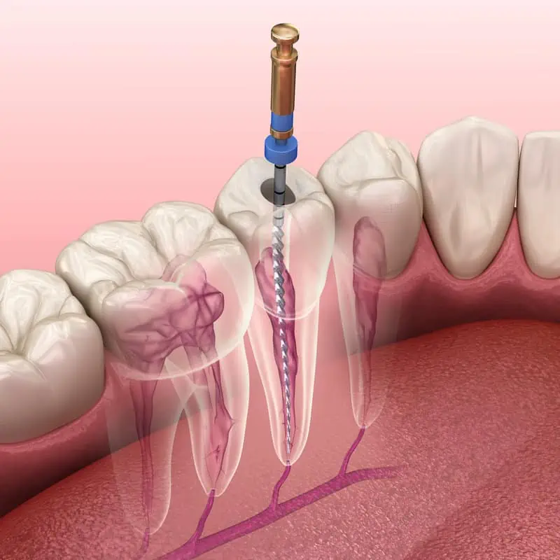 Root Canal by 24streetdentalphoenix in us