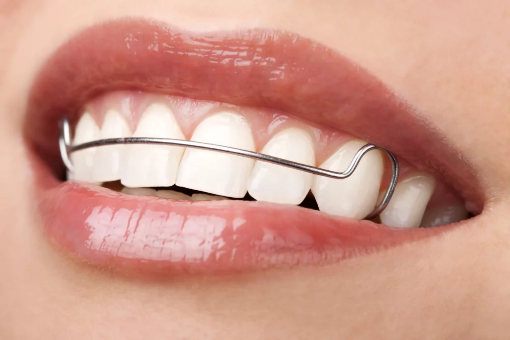 Mouth Guards and Retainers in phoenix, AZ | 24th Street Dental