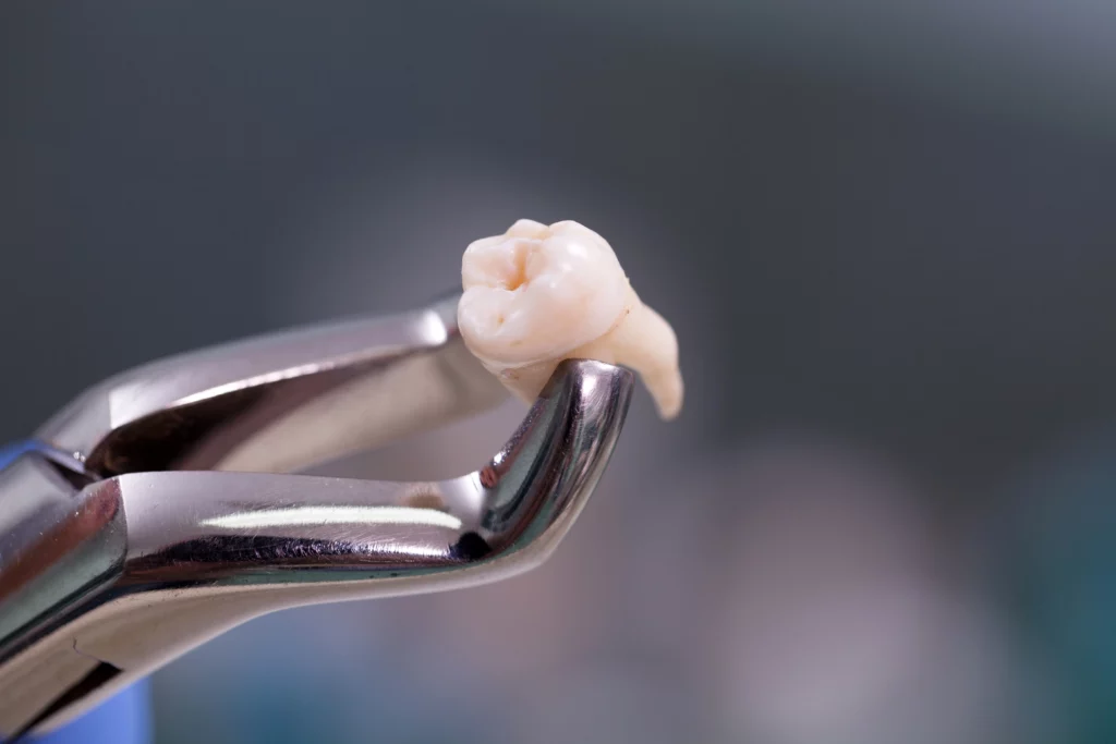 Oral-surgery-tooth-extractions | 24th Street Dental in Phoenix, AZ