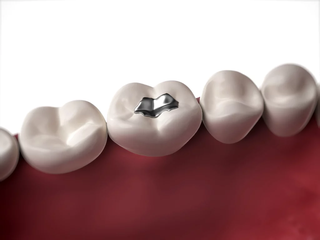 Tooth with dental filling close-up | 24th Street Dental in Phoenix, AZ