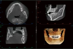 3D dental CBCT scan showing cross-section images of teeth and jaw | 24th Street Dental in Phoenix, AZ