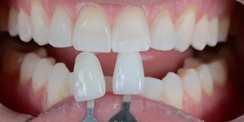 Patient teeth transformation through professional dental care in Phoenix, AZ | 24th Street Dental Biltmore