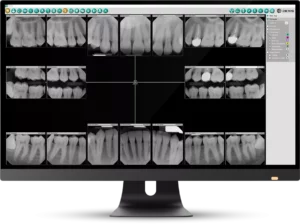 Monitor showing full-mouth dental X-ray images for diagnosis | 24th Street Dental in Phoenix, AZ