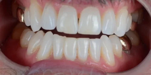 Close-up of after Resin Composite (Metal-Free) Fillings in phoenix, AZ | 24th Street Dental Biltmore