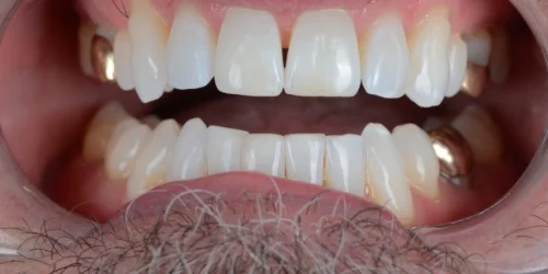 Close-up of before Resin Composite (Metal-Free) Fillings in phoenix, AZ | 24th Street Dental Biltmore