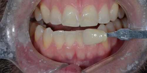 Patient teeth transformation through professional dental care in Phoenix, AZ | 24th Street Dental Biltmore
