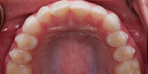 Close-up of teeth after Invisalign treatment at 24th Street Dental in Phoenix, AZ