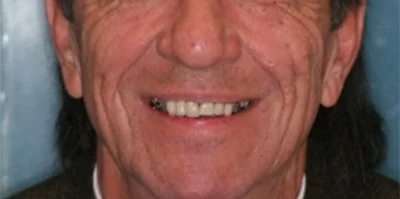 Close-up of teeth before treatment in Phoenix, AZ | 24th Street Dental Biltmore