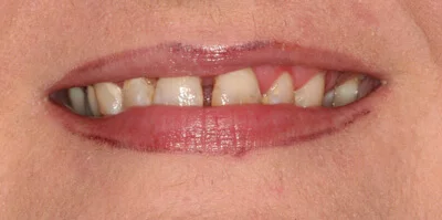 Close-up of teeth before treatment in Phoenix, AZ | 24th Street Dental Biltmore