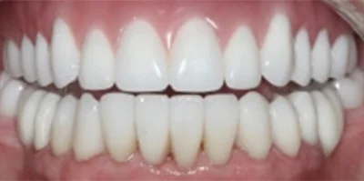 Close-up of teeth after treatment in Phoenix, AZ | 24th Street Dental Biltmore