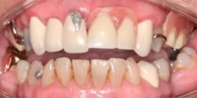 Close-up of teeth before treatment in Phoenix, AZ | 24th Street Dental Biltmore