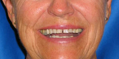 Close-up of teeth before treatment in Phoenix, AZ | 24th Street Dental Biltmore
