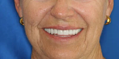 Close-up of teeth after treatment in Phoenix, AZ | 24th Street Dental Biltmore