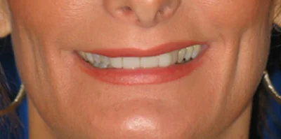 Close-up of teeth before treatment in Phoenix, AZ | 24th Street Dental Biltmore