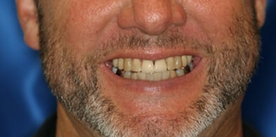 Close-up of teeth before treatment in Phoenix, AZ | 24th Street Dental Biltmore