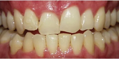 Patient teeth transformation through professional dental care in Phoenix, AZ | 24th Street Dental Biltmore