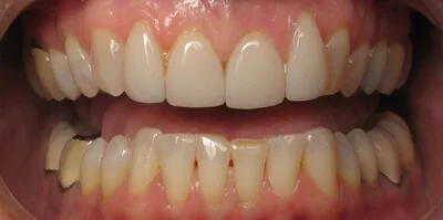 Close-up of teeth before treatment in Phoenix, AZ | 24th Street Dental Biltmore