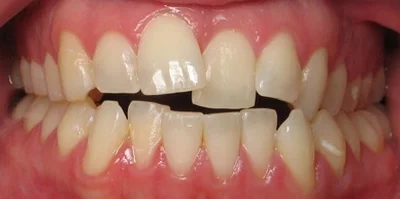 Close-up of teeth after treatment in Phoenix, AZ | 24th Street Dental Biltmore