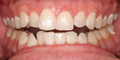 Close-up of teeth before treatment in Phoenix, AZ | 24th Street Dental Biltmore
