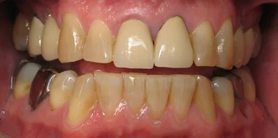 Close-up of teeth before treatment in Phoenix, AZ | 24th Street Dental Biltmore