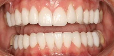 Close-up of teeth after treatment in Phoenix, AZ | 24th Street Dental Biltmore
