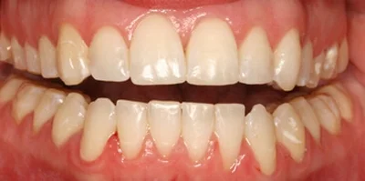 Close-up of teeth before treatment in Phoenix, AZ | 24th Street Dental Biltmore
