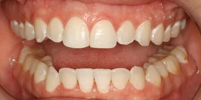 Close-up of teeth after treatment in Phoenix, AZ | 24th Street Dental Biltmore