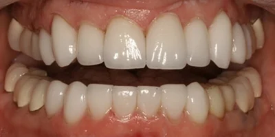 Close-up of teeth after treatment in Phoenix, AZ | 24th Street Dental Biltmore