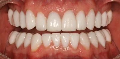 Close-up of teeth after treatment in Phoenix, AZ | 24th Street Dental Biltmore