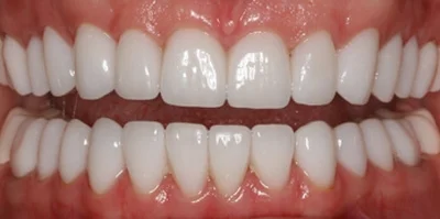 Close-up of teeth after treatment in Phoenix, AZ | 24th Street Dental Biltmore