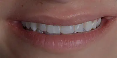 Patient teeth transformation through professional dental care in Phoenix, AZ | 24th Street Dental Biltmore