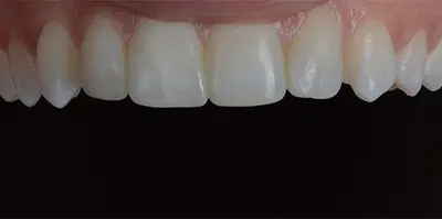 Patient teeth transformation through professional dental care in Phoenix, AZ | 24th Street Dental Biltmore