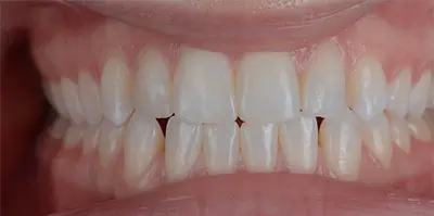 Close-up of teeth after treatment in Phoenix, AZ | 24th Street Dental Biltmore