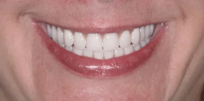 Patient teeth transformation through professional dental care in Phoenix, AZ | 24th Street Dental Biltmore