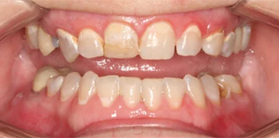 Close-up of teeth before treatment in Phoenix, AZ | 24th Street Dental Biltmore