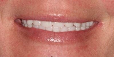 Close-up of teeth after treatment in Phoenix, AZ | 24th Street Dental Biltmore