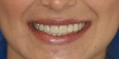 Close-up of teeth after treatment in Phoenix, AZ | 24th Street Dental Biltmore
