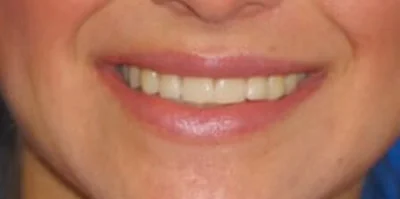 Close-up of teeth before treatment in Phoenix, AZ | 24th Street Dental Biltmore