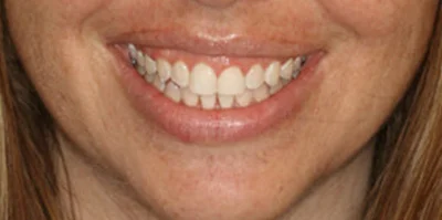 Close-up of teeth after treatment in Phoenix, AZ | 24th Street Dental Biltmore