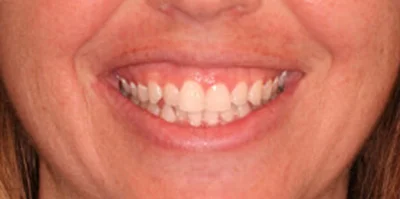 Close-up of teeth before treatment in Phoenix, AZ | 24th Street Dental Biltmore