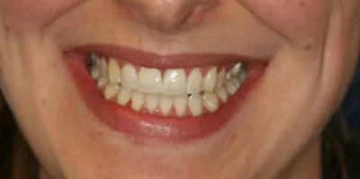 Patient teeth transformation through professional dental care in Phoenix, AZ | 24th Street Dental Biltmore