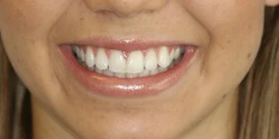 Patient teeth transformation through professional dental care in Phoenix, AZ | 24th Street Dental Biltmore
