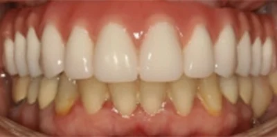 Close-up of teeth before treatment in Phoenix, AZ | 24th Street Dental Biltmore