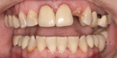 Close-up of teeth before treatment in Phoenix, AZ | 24th Street Dental Biltmore