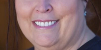 Patient teeth transformation through professional dental care in Phoenix, AZ | 24th Street Dental Biltmore