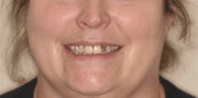 Close-up of teeth before treatment in Phoenix, AZ | 24th Street Dental Biltmore