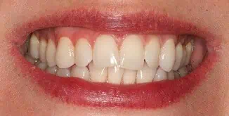 Close-up of teeth before treatment in Phoenix, AZ | 24th Street Dental Biltmore