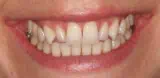 Close-up of teeth before treatment in Phoenix, AZ | 24th Street Dental Biltmore