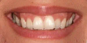Close-up of teeth before treatment in Phoenix, AZ | 24th Street Dental Biltmore