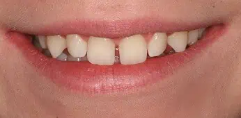 Close-up of teeth before treatment in Phoenix, AZ | 24th Street Dental Biltmore